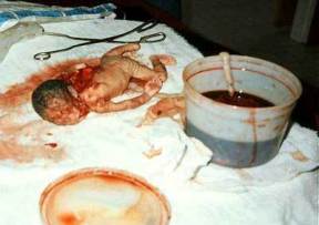 abortion graphic image